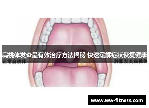 扁桃体发炎最有效治疗方法揭秘 快速缓解症状恢复健康
